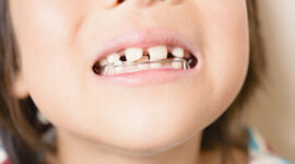 すきっ歯の子供