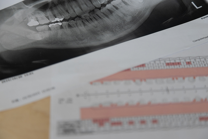 歯周病検査の種類