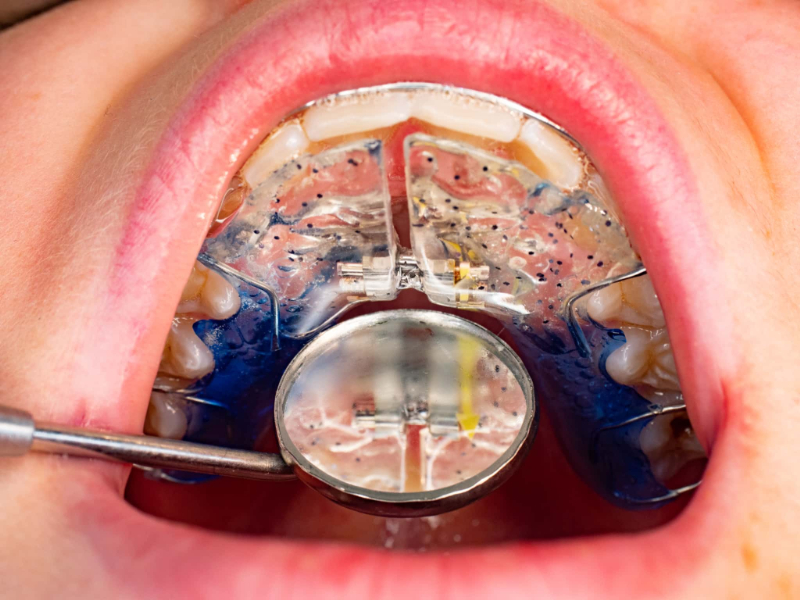 床矯正中に生じる痛みを和らげるために歯科医院でチェックしてもらうイメージ