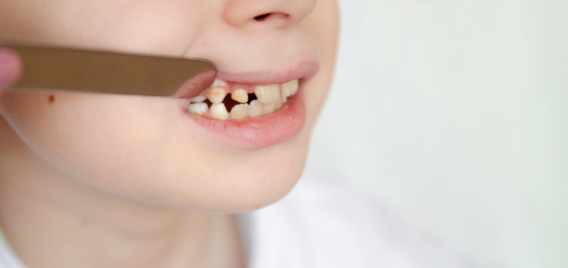 八重歯をそのままにし虫歯になってしまった子ども