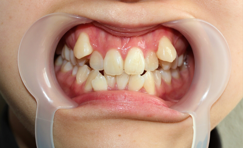 八重歯の症例写真