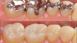 銀歯からセラミックの歯にしたビフォーアフター