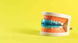 マイオブレースを装着した歯の模型