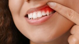歯周病で歯茎が腫れている女性