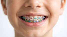 小児矯正をしている子ども