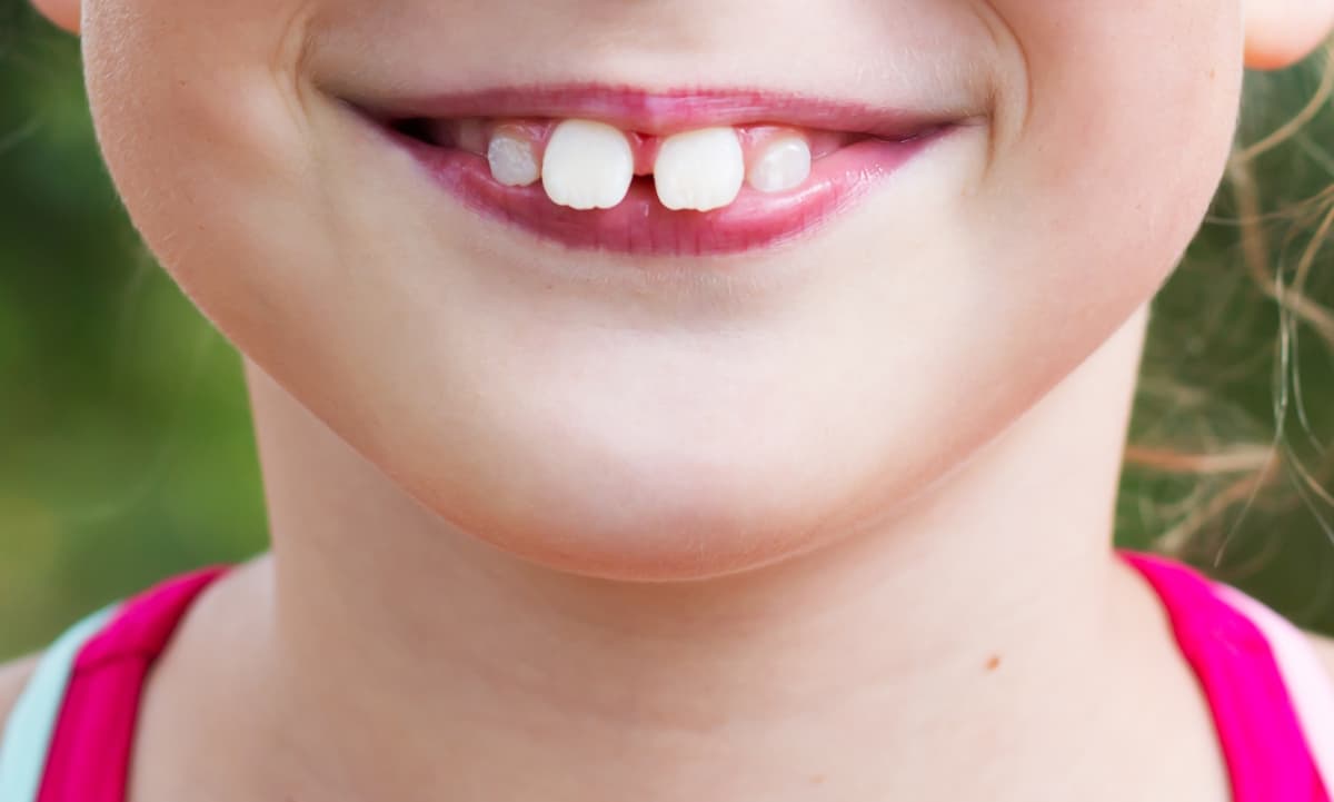 出っ歯の子どもの口元